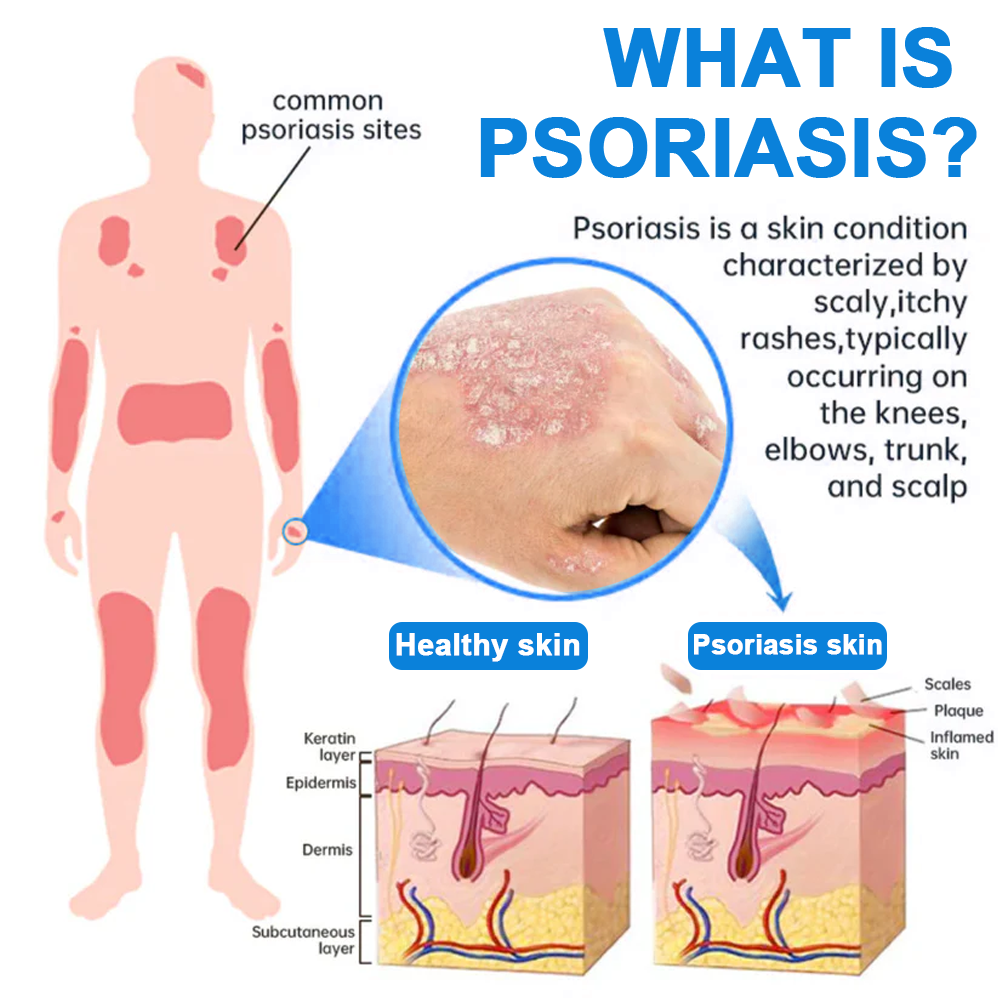 ✅ Official Store: Zvoevo® Magnesium Herbal Psoriasis Spray 👨⚕️ FDA Certified (for the treatment of psoriasis and eczema, improvement of bacterial infections in the genital area, treatment of acne and warts)