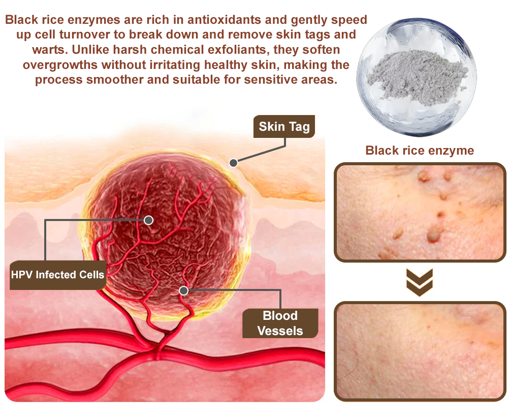 Zvoevo® Rice Bran Extract Cream 👨⚕️ FDA-Certified (For removing warts and skin growths, eliminating keratin buildup and skin hyperplasia, treating skin cancer, hyperpigmentation, and age spots)