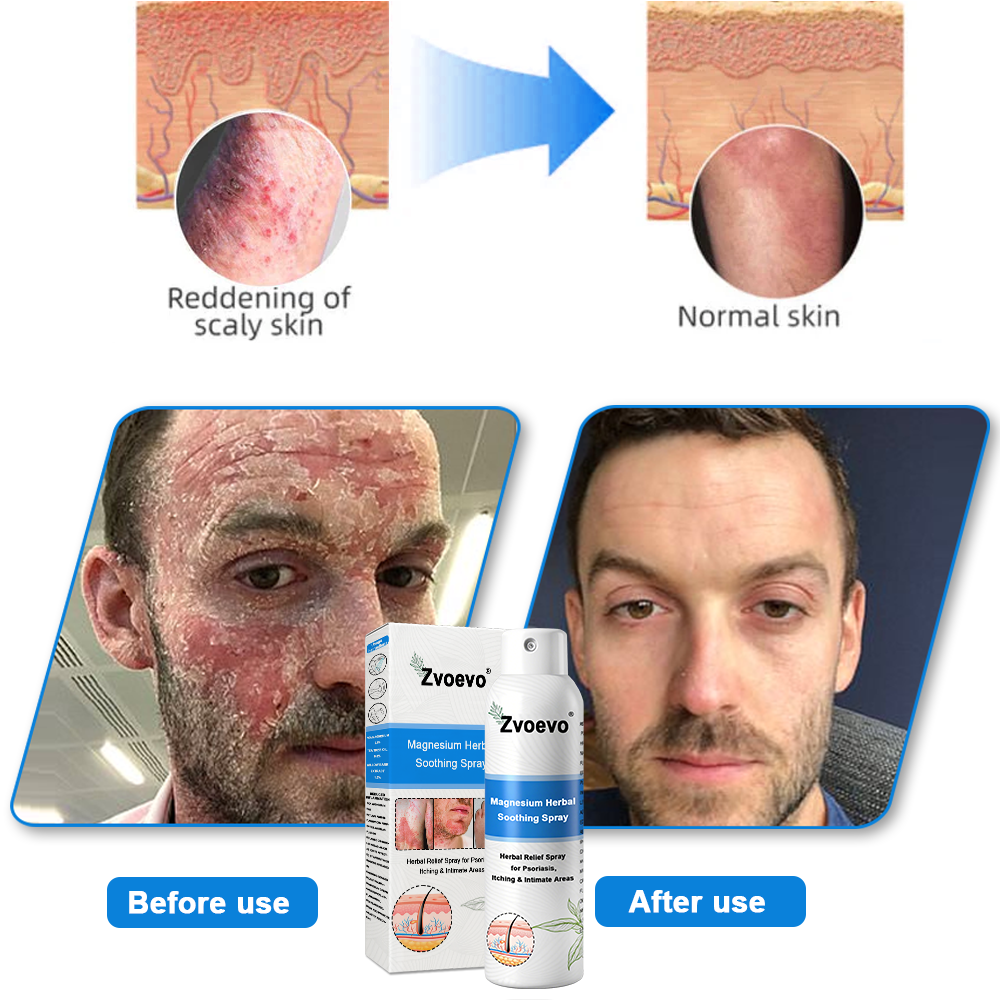 ✅ Official Store: Zvoevo® Magnesium Herbal Psoriasis Spray 👨⚕️ FDA Certified (for the treatment of psoriasis and eczema, improvement of bacterial infections in the genital area, treatment of acne and warts)