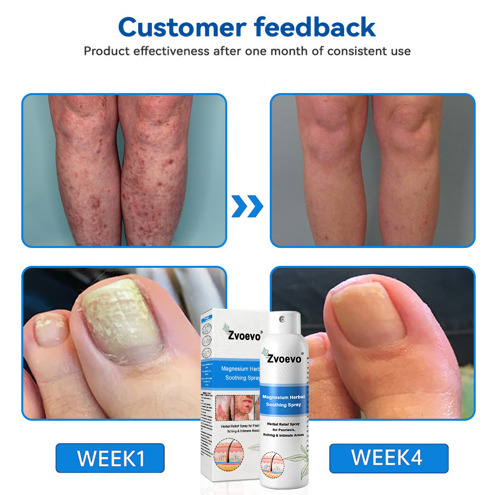✅ Official Store: Zvoevo® Magnesium Herbal Psoriasis Spray 👨⚕️ FDA Certified (for the treatment of psoriasis and eczema, improvement of bacterial infections in the genital area, treatment of acne and warts)