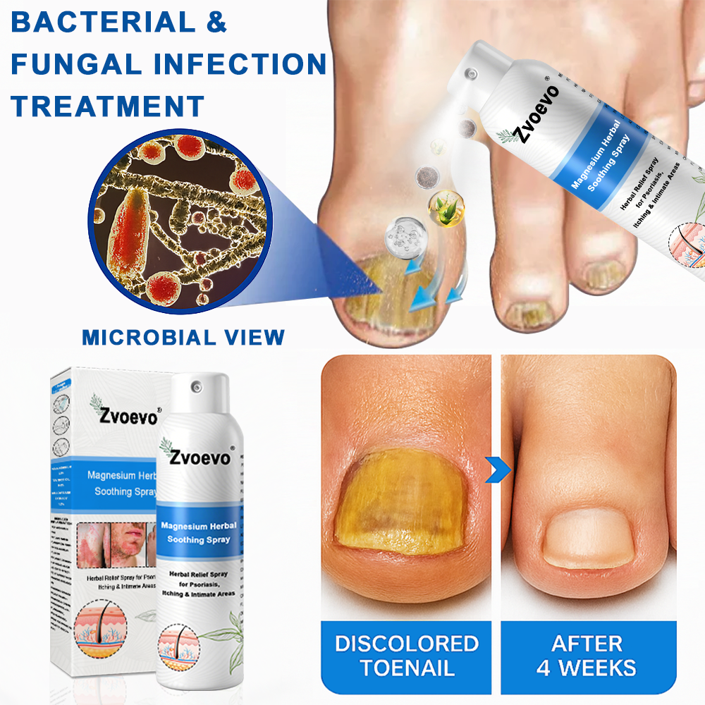 ✅ Official Store: Zvoevo® Magnesium Herbal Psoriasis Spray 👨⚕️ FDA Certified (for the treatment of psoriasis and eczema, improvement of bacterial infections in the genital area, treatment of acne and warts)