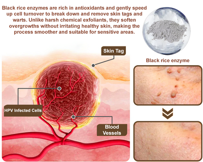 Zvoevo® Black Rice Skin Repair Essence Cream ⚕️ FDA Certified (Eliminates warts and skin tags, relieves psoriasis, improves keratin build-up and follicular keratinization, fades pigmentation, sun spots & age spots)