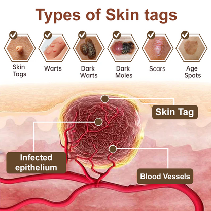 Zvoevo® Black Rice Skin Repair Essence Cream ⚕️ FDA Certified (Eliminates warts and skin tags, relieves psoriasis, improves keratin build-up and follicular keratinization, fades pigmentation, sun spots & age spots)