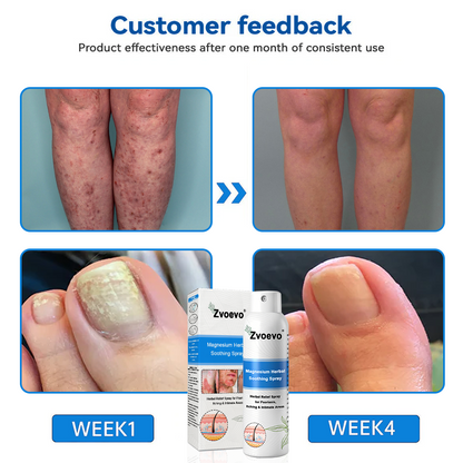 ✅ Official Store: Zvoevo® Magnesium Herbal Psoriasis Spray 👨‍⚕️ FDA Certified (Relieves Psoriasis and Eczema, Improves Bacterial Infections in the Genital Area, Treats Acne and Warts)